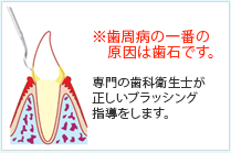 歯周病