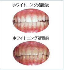 ホワイトニング